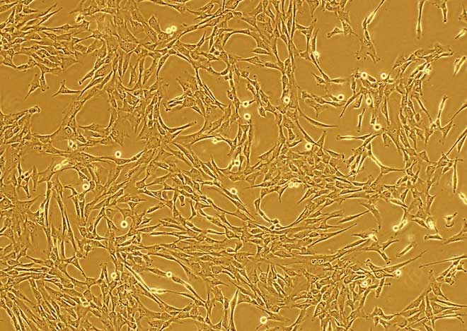 脐带间充质干细胞 多发症硬化 脐带间充质干细胞 多发症硬化